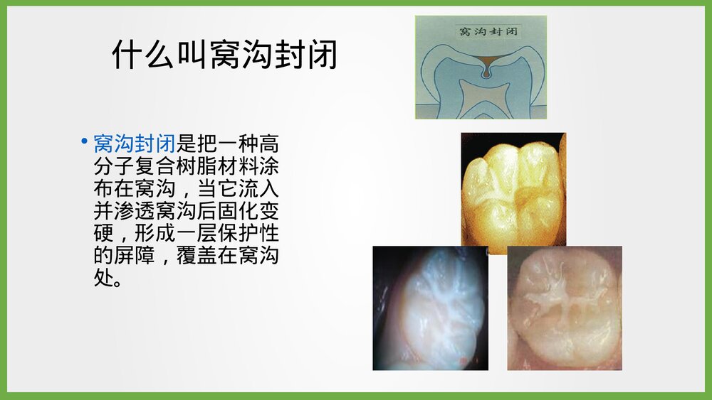 儿童窝沟封闭项目简介PPT课件6