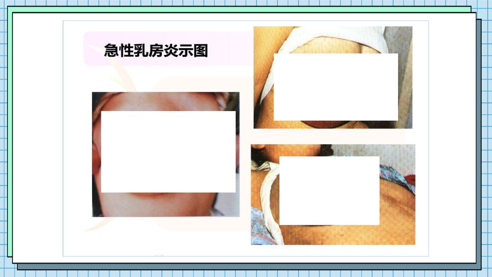 急性乳腺炎的防护及预防PPT课件下载9