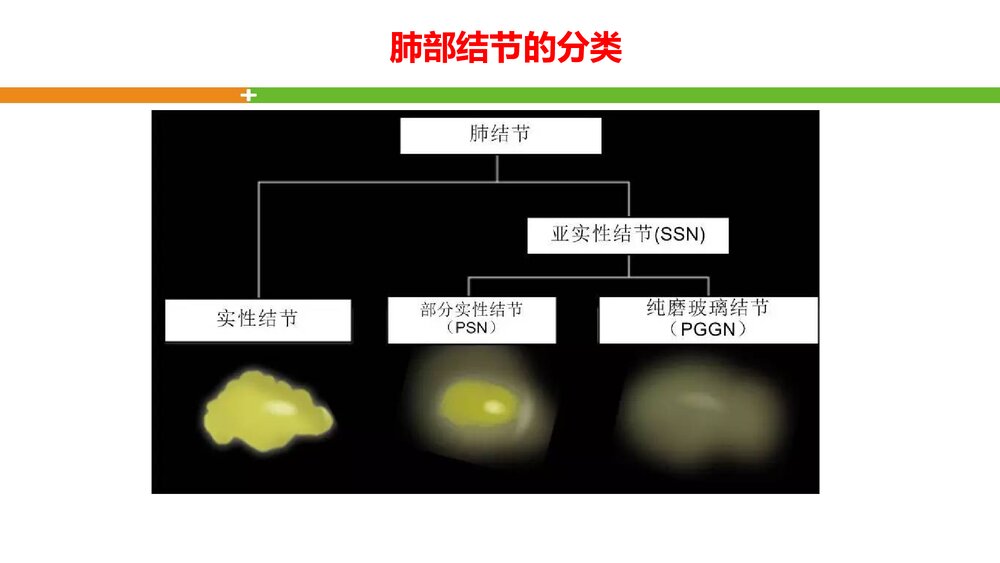 肺结节的评估PPT课件下载4