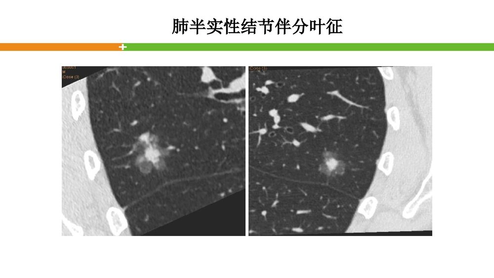 肺结节的评估PPT课件下载6