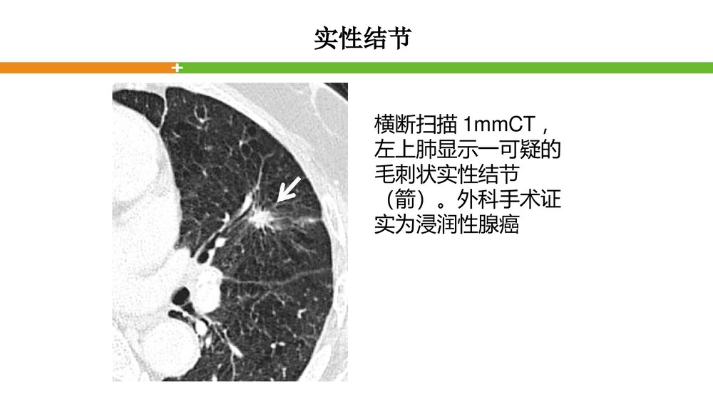 肺结节的评估PPT课件下载7