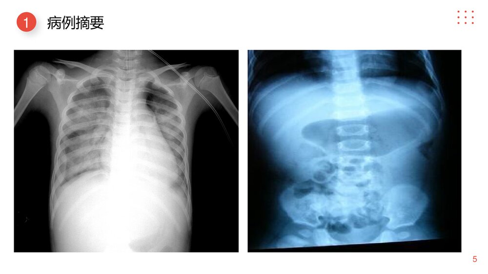 小儿肠套叠护理查房PPT课件下载5
