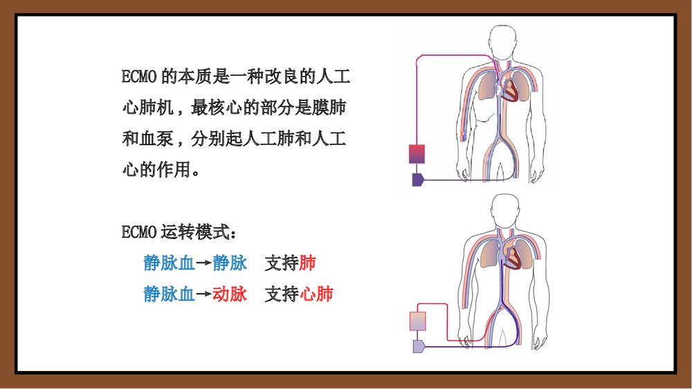 ECMO体外膜肺氧和护理PPT课件下载7