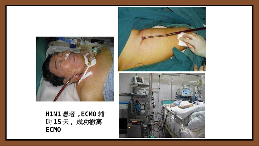 ECMO体外膜肺氧和护理PPT课件下载10