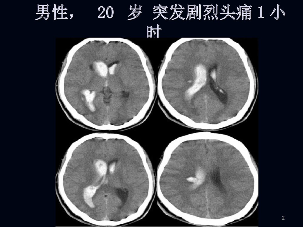 烟雾病影像诊断PPT课件下载2