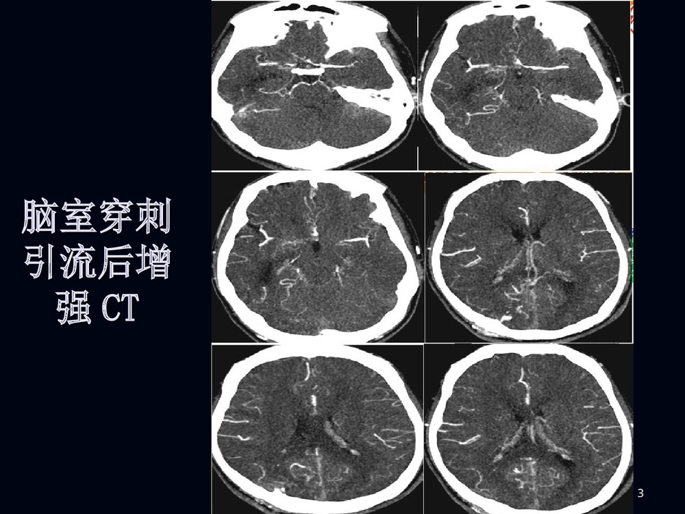 烟雾病影像诊断PPT课件下载3