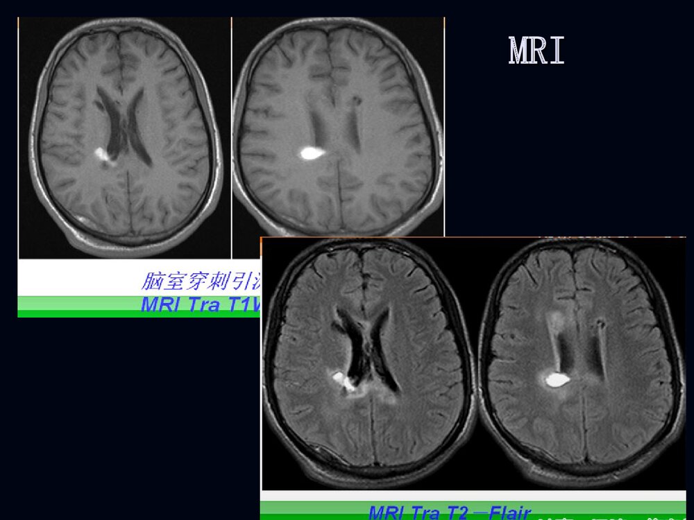 烟雾病影像诊断PPT课件下载4
