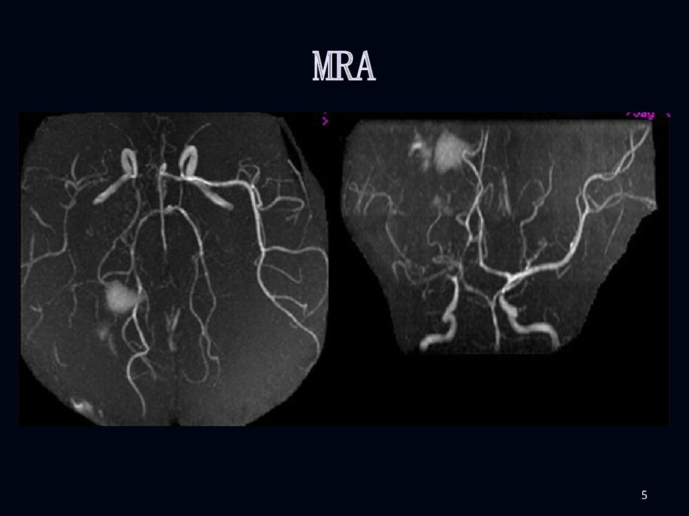 烟雾病影像诊断PPT课件下载5