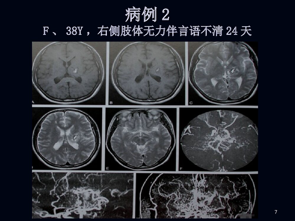 烟雾病影像诊断PPT课件下载7