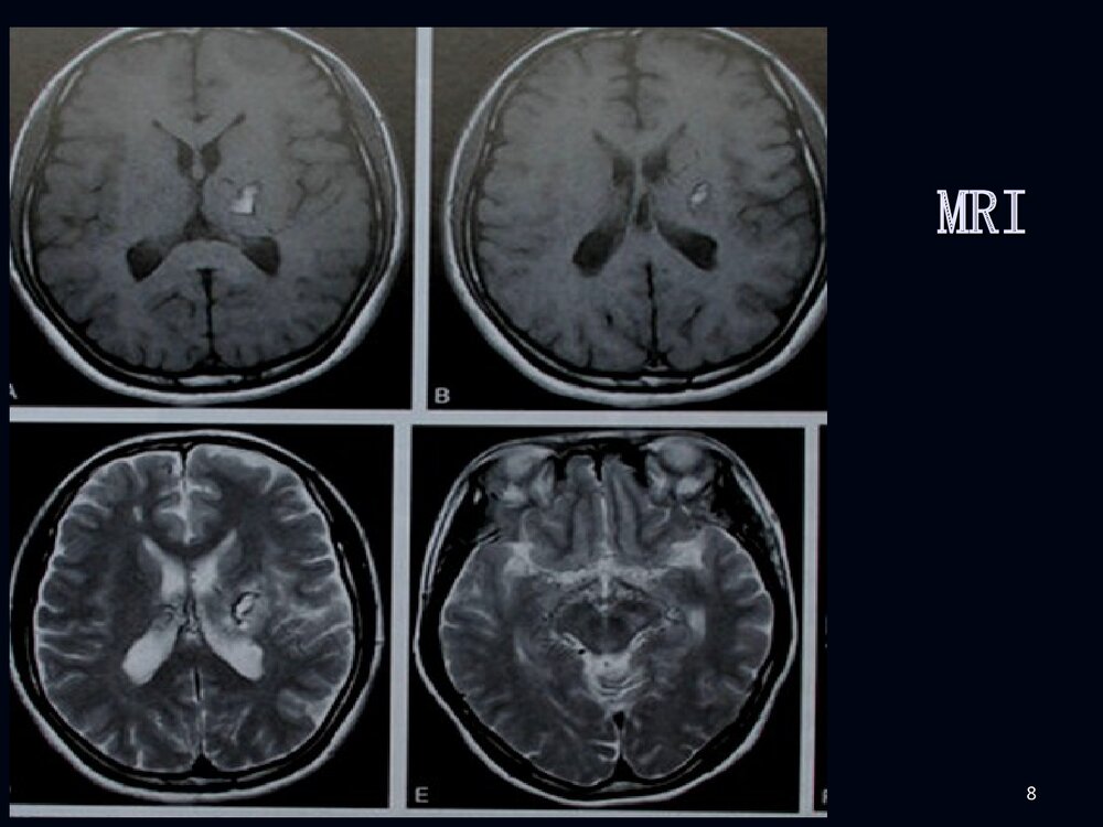 烟雾病影像诊断PPT课件下载8
