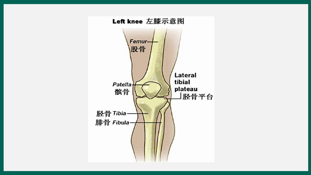 胫骨平台骨折患者护理查房PPT课件下载4