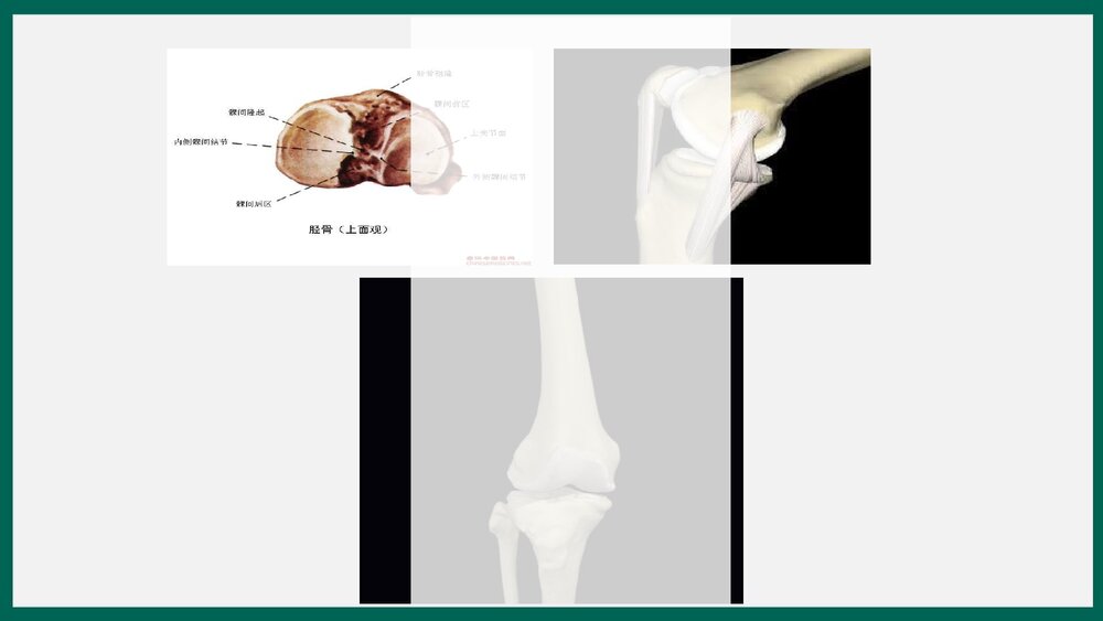胫骨平台骨折患者护理查房PPT课件下载5