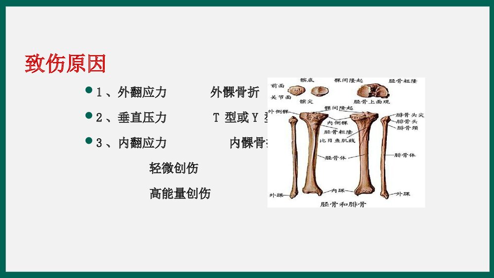 胫骨平台骨折患者护理查房PPT课件下载7