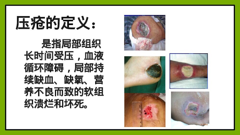 压疮的护理方法PPT课件4