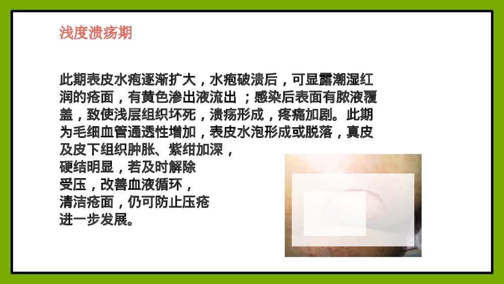 压疮的护理方法PPT课件9