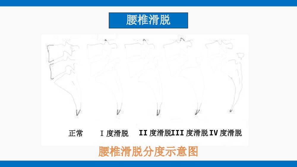 腰椎滑脱护理查房PPT课件10